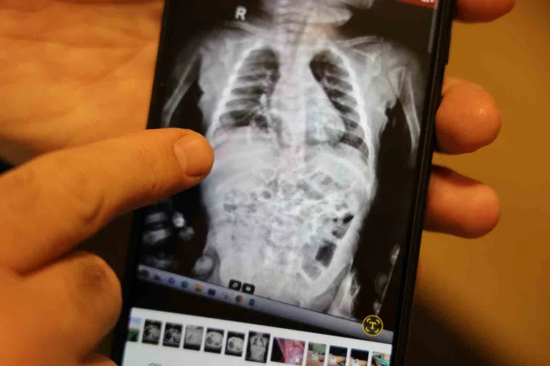 Doğuştan 200 binde bir görülen hastalıkla 2 yıl boyunca yaşayan çocuk sağlığına kavuştu
