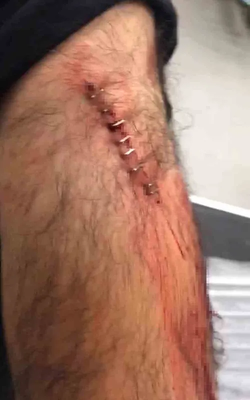 Şanlıurfa’da görev yapan öğretmene sokak ortasında jiletli saldırı
