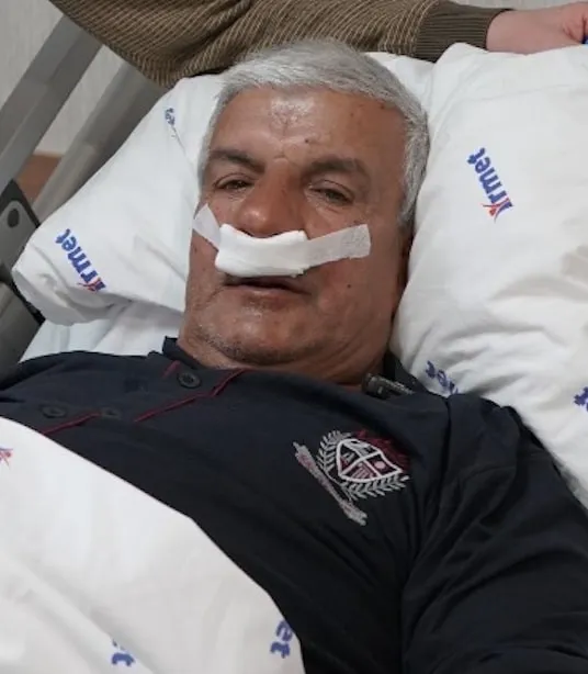 65 yaşındaki adamın burnundan 100 gramlık taş çıkarıldı
