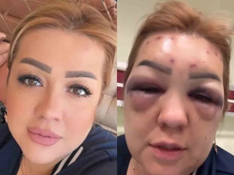 Botoks bu hale getirdi: Yüzü şişti tanınmayacak hale geldi
